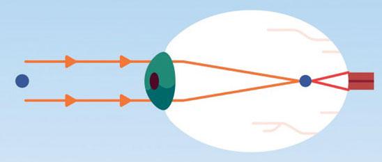 longueur oeil myope