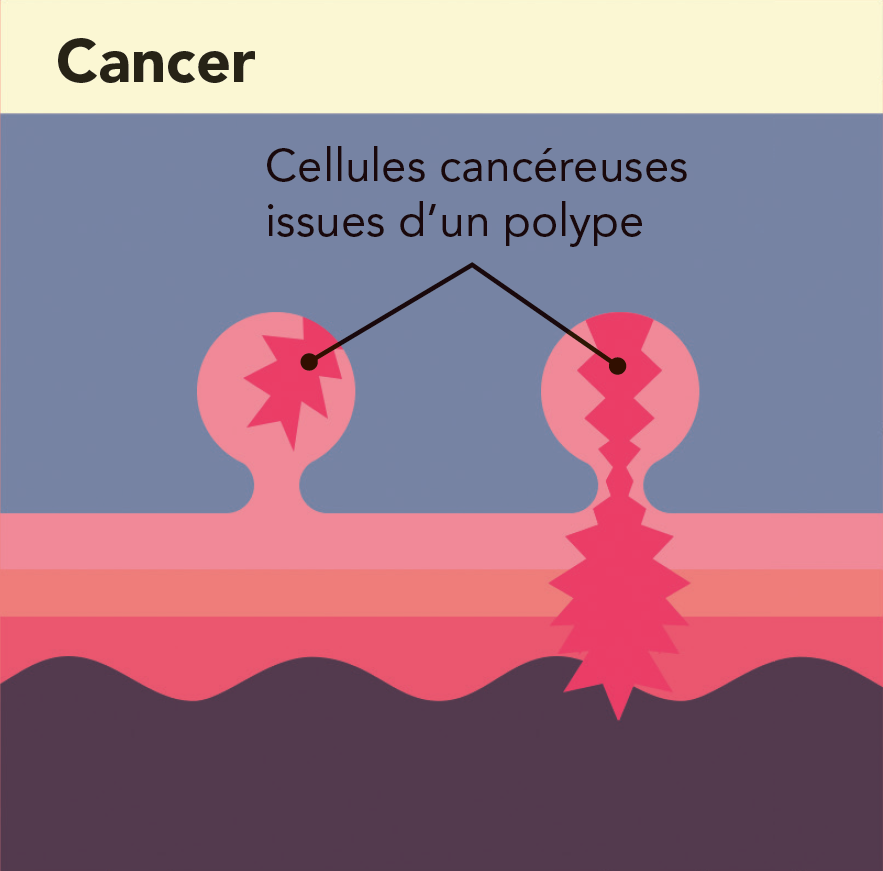 Cancer polype