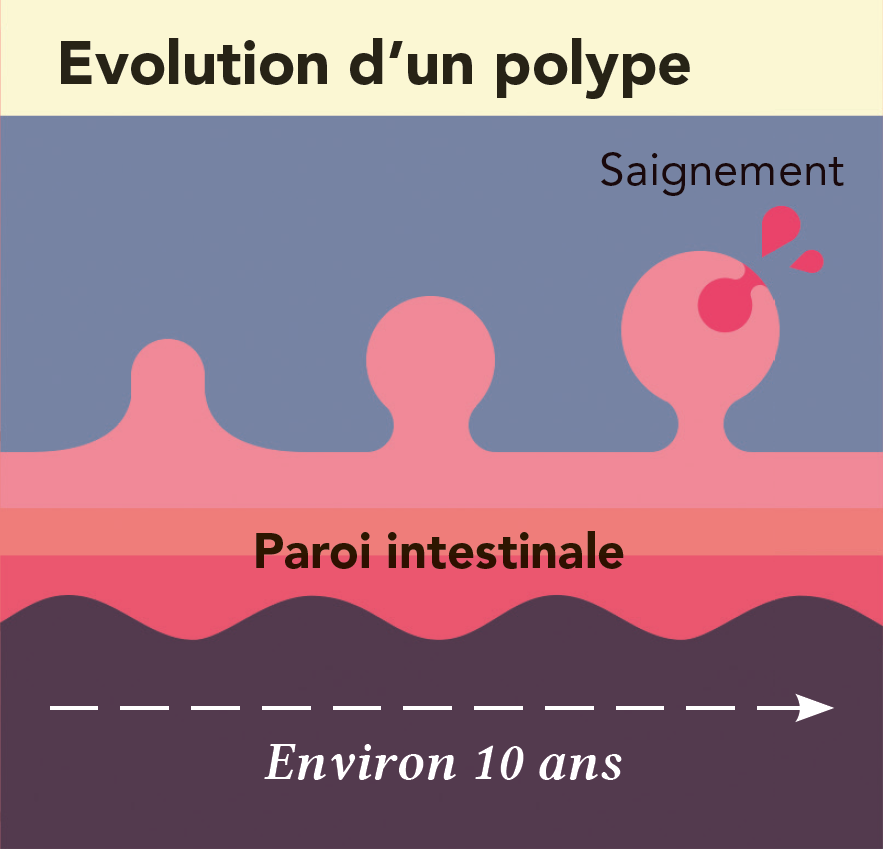 evolution du polype