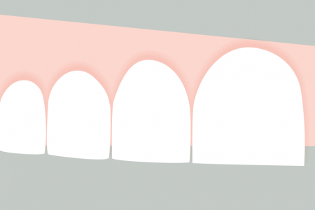 illustration dents