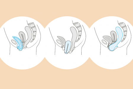 illustration descente d'organe