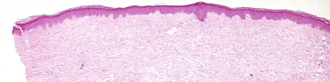 actualite-sclerodermie