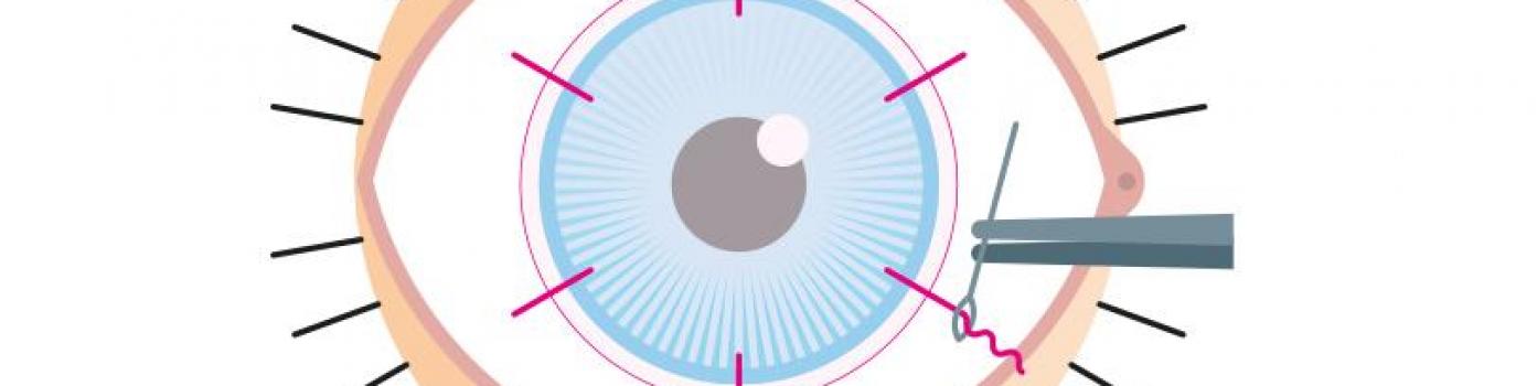 Des patchs de membrane amniotique pour réparer les cornées