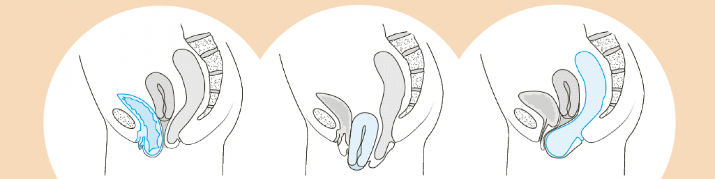 illustration descente d'organe