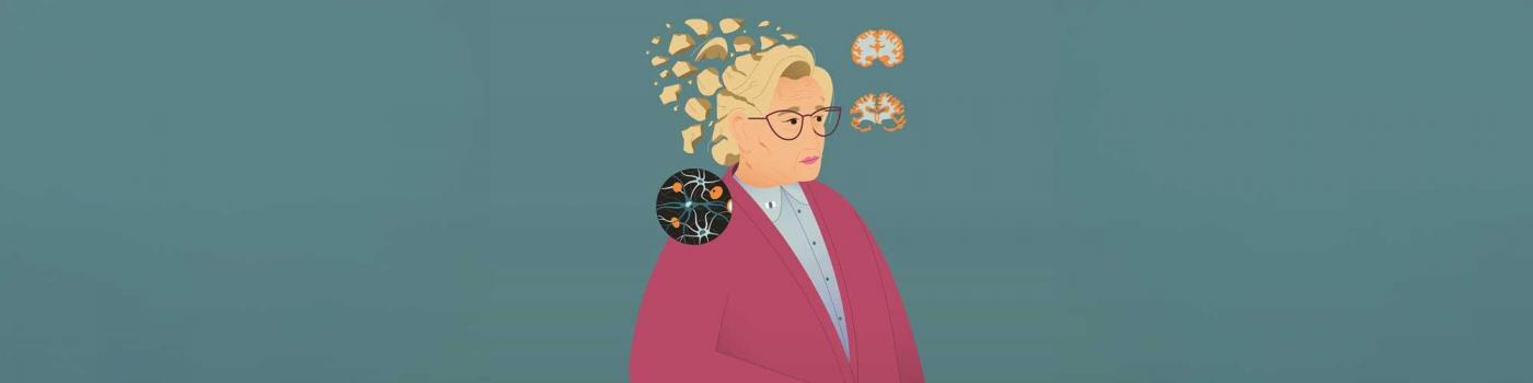 illustration : la maladie d’Alzheimer