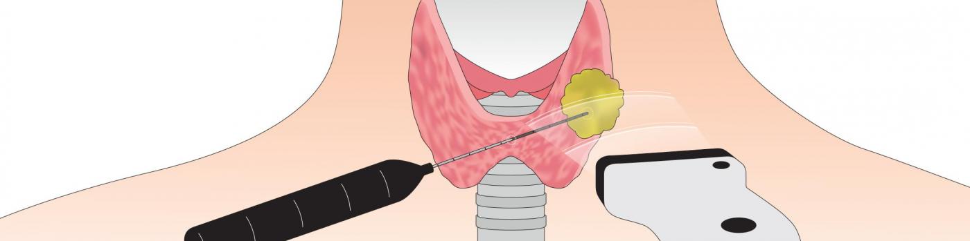 illustration : radiofréquence pour détruire les nodules thyroïdiens