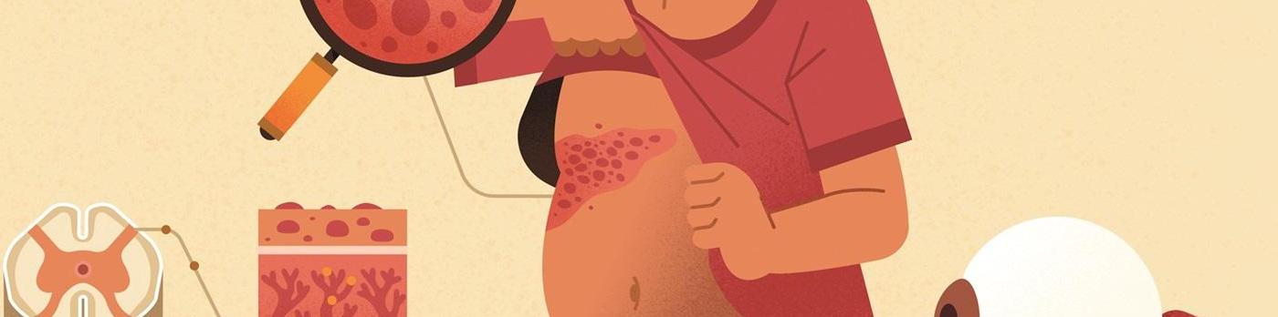 illustration : Le zona