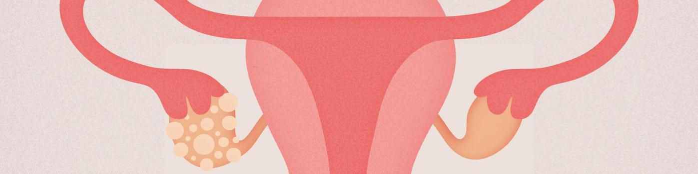 Le syndrome des ovaires polykystiques, un mal encore sous-estimé