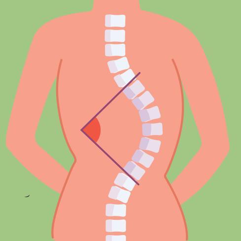 scoliose - angle de Cobb scoliose - angle de Cobb