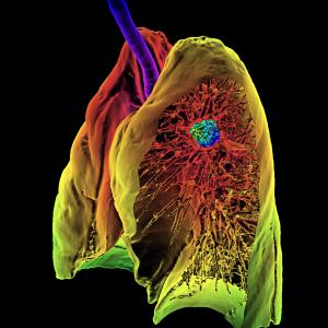 À la pointe de la lutte contre le cancer du poumon