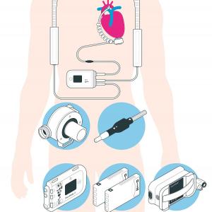 insuffisance cardiaque