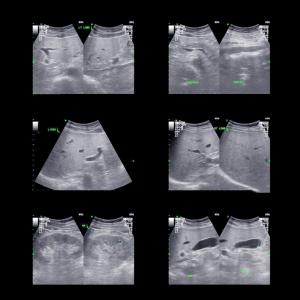 ultrasonographie ciblée 