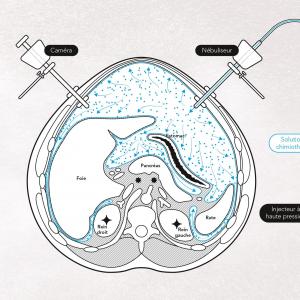 Schéma explicatif de la chimiothérapie par aérosol