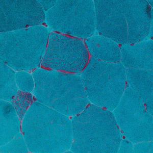 troubles métaboliques