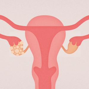Le syndrome des ovaires polykystiques, un mal encore sous-estimé