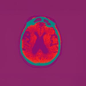 Alzheimer: un nouveau médicament enfin disponible