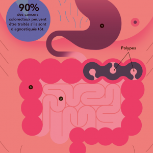 Cancer du côlon : Dépister pour diminuer la mortalité