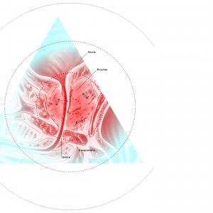 Radiothérapie contre le cancer de la prostate : un GPS révolutionnaire