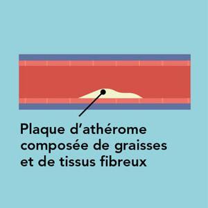 Plaque d’athérome composée de graisses et de tissus fibreux Plaque d’athérome composée de graisses et de tissus fibreux