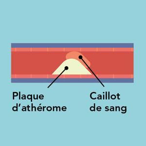 Formation d’un caillot de sang