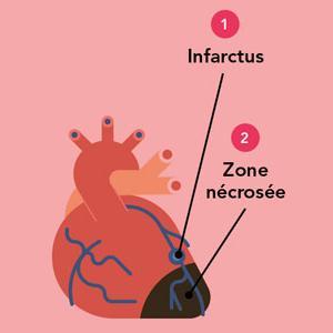 Infarctus