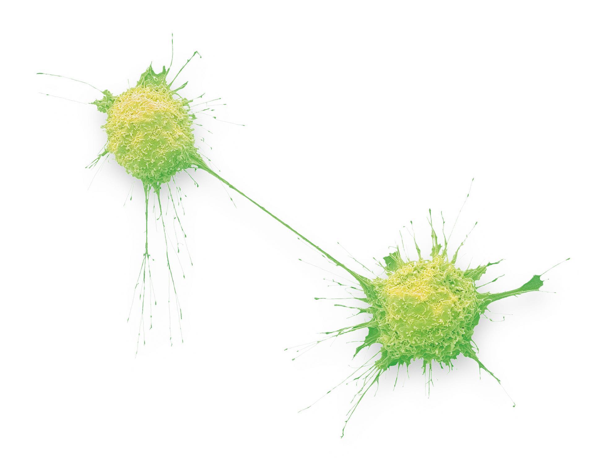 Cellule cancéreuse de prostate en cours de division (image grossie 2000x). Cellule cancéreuse d’ostéosarcome (image grossie 4000x).