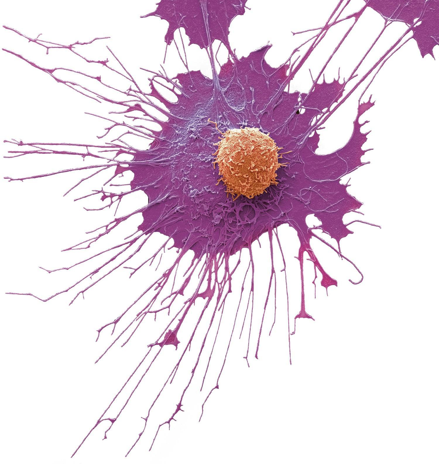 Cellule T (en orange) et cellule cancéreuse de la prostate (en violet). Les cellules T sont un composant du système immunitaire de l’organisme (image grossie 6000x).