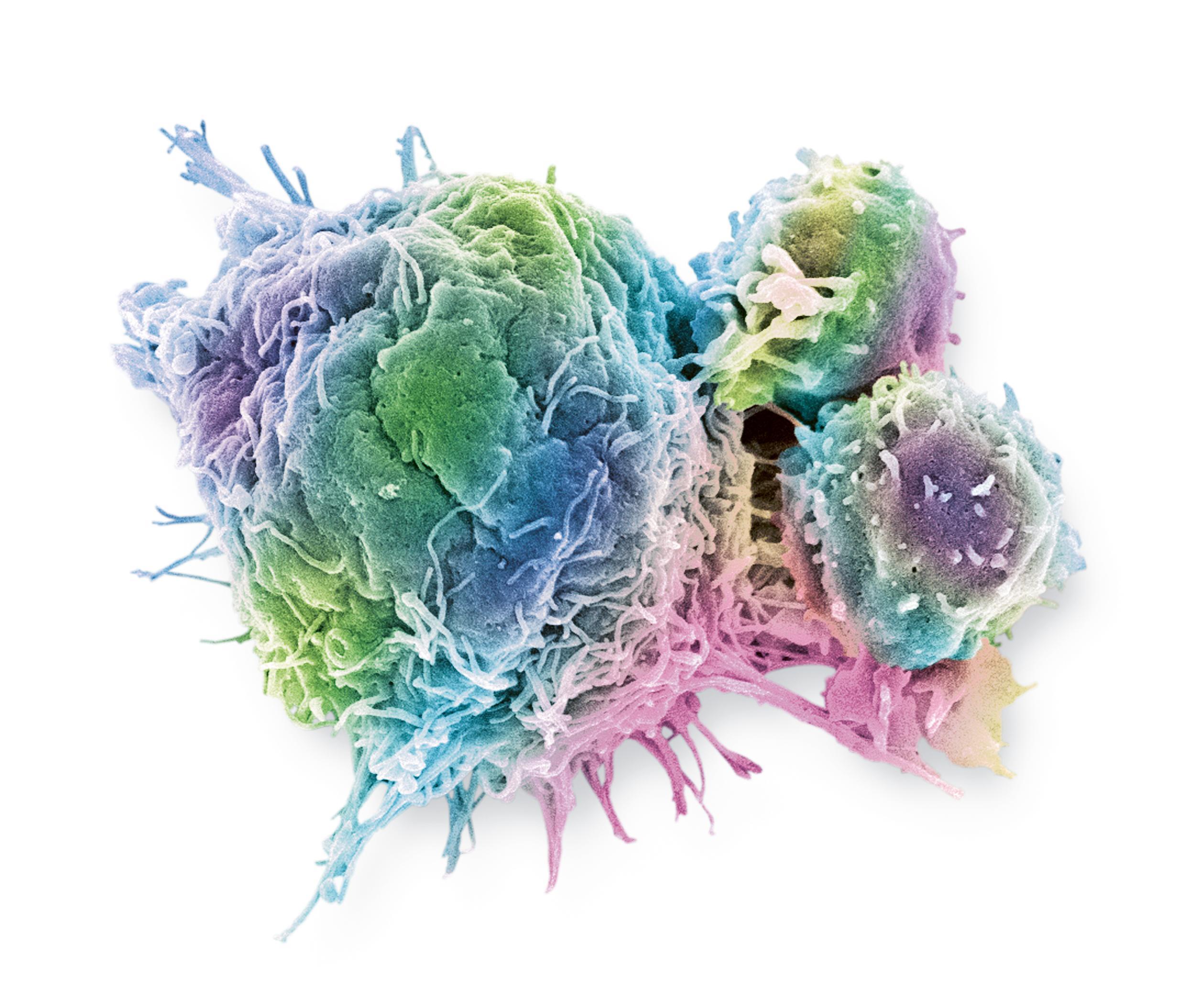 Cellule cancéreuse colorectale (image grossie 3000x). Lymphocytes T (petites cellules rondes) attachés à une cellule cancéreuse (image grossie 5000x).