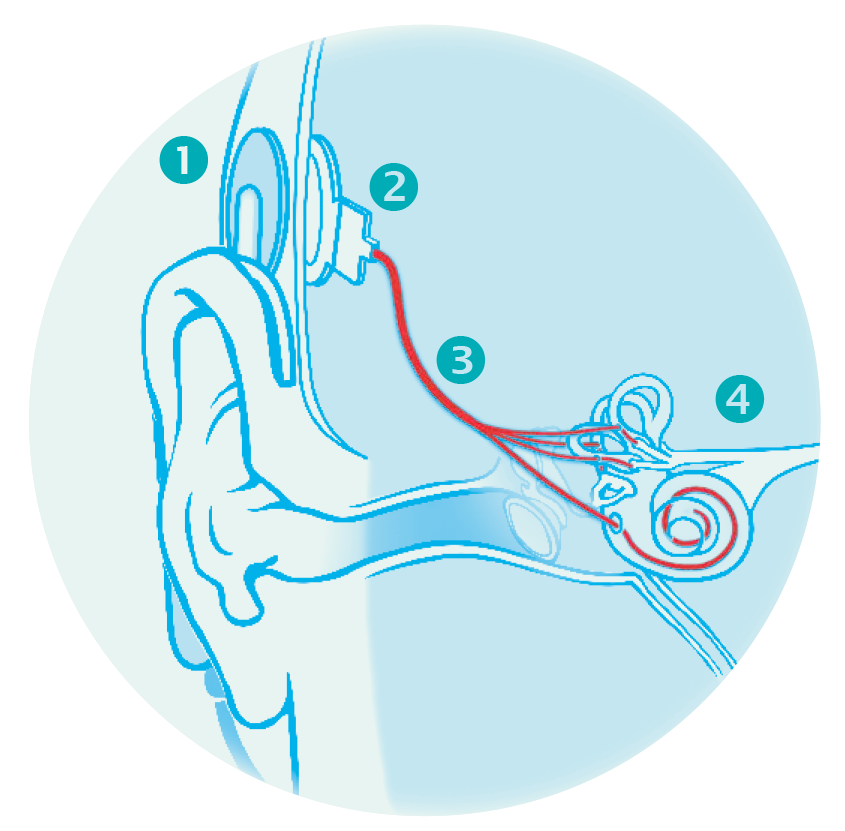 neuroprothèse