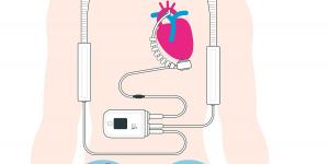 insuffisance cardiaque