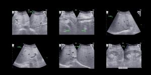 ultrasonographie ciblée 