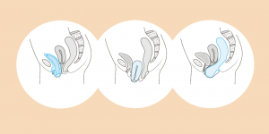 illustration descente d'organe