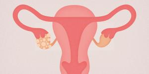Le syndrome des ovaires polykystiques, un mal encore sous-estimé